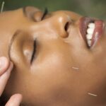 5 Benefits of Acupuncture