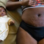 Everything To Know About Stretch Marks On Darker Skin