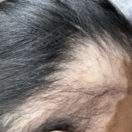 I Tried PRP Hair Restoration – Here’s How It Went