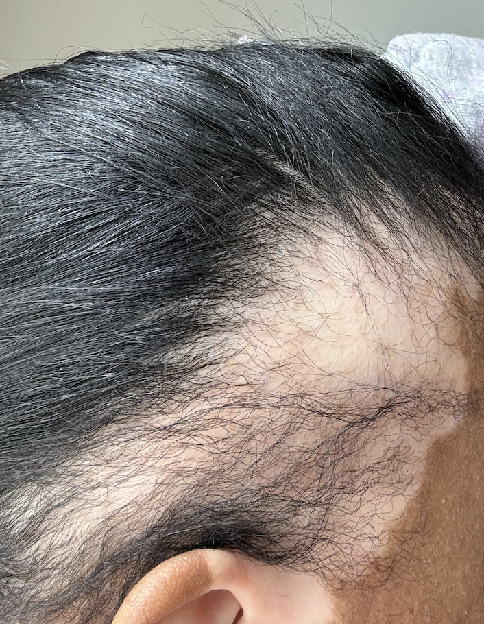 I Tried PRP Hair Restoration – Here’s How It Went